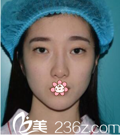 術(shù)前我眼睛一單一雙 術(shù)前我眼睛一單一雙