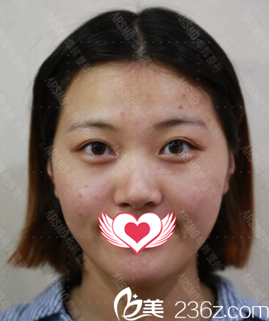 術(shù)前照 術(shù)前照