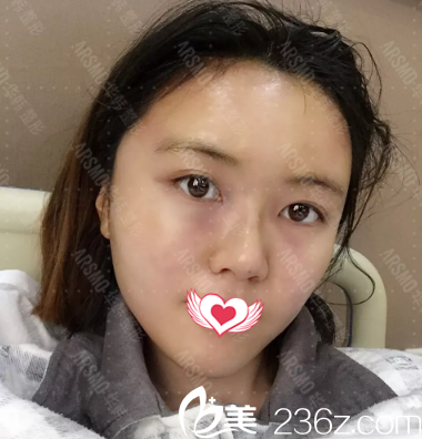 自體脂肪填充全臉術(shù)后天 自體脂肪填充全臉術(shù)后天