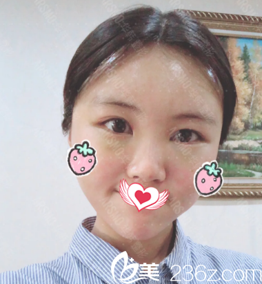 面部脂肪填充術(shù)后第7天 面部脂肪填充術(shù)后第7天