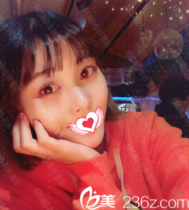 術(shù)后一個(gè)月效果 術(shù)后一個(gè)月效果