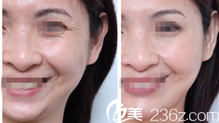 Dr. Lee注射瘦臉除皺案例