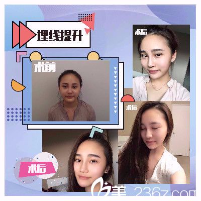 香港FMH醫(yī)學(xué)美容線雕提升真人案例