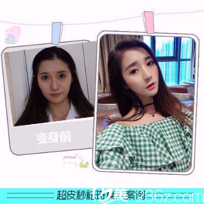 香港FMH醫(yī)學(xué)美容超皮秒祛斑案例