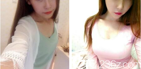 泰國KTOP整形假體豐胸案例