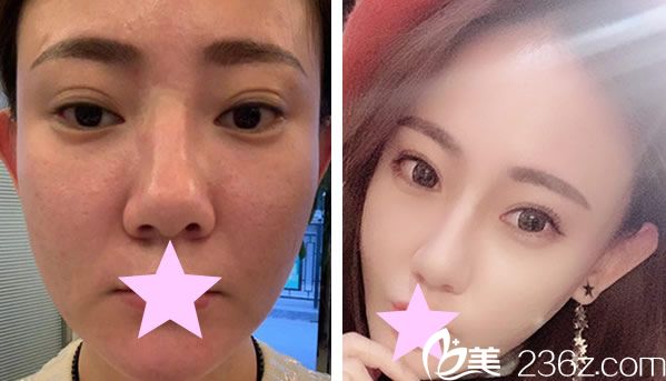 村哈羅特里醫(yī)生面部線雕提升+鼻翼縮小術(shù)效果對比圖