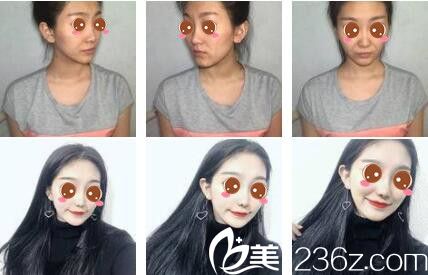 香港美生堂醫(yī)學(xué)美容林醫(yī)生第二代童顏針注射真人案例 香港美生堂醫(yī)學(xué)美容林醫(yī)生第二代童顏針注射真人案例