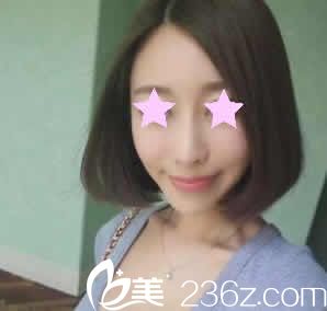 南寧華美整形劉真俊院長給我做線雕提升后第5天照片
