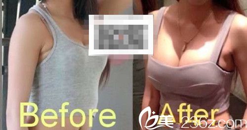 隆胸手術(shù)案例展示