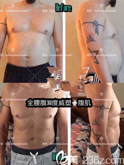 吸脂瘦身案例展示