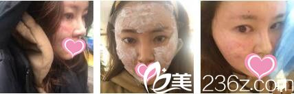 香港美生堂醫(yī)學(xué)美容中心林醫(yī)生面部埋線提升真人案例術(shù)后天