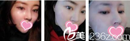 香港美生堂醫(yī)學(xué)美容中心林醫(yī)生面部埋線提升真人案例術(shù)后第七天