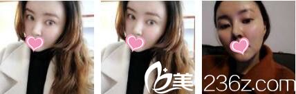 香港美生堂醫(yī)學(xué)美容中心林醫(yī)生面部埋線提升真人案例術(shù)后十五天