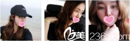 香港哪家醫(yī)院做線雕靠譜？二十八天前我在香港美生堂做了面部埋線提升現(xiàn)在給大家看看效果圖