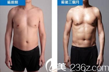 威塑4D脂肪雕刻技術(shù)手術(shù)前后對(duì)比照片