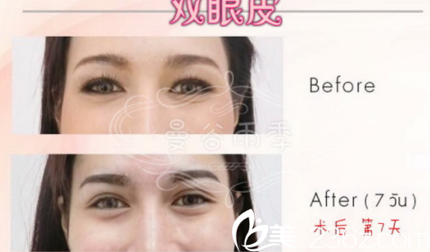 雙眼皮手術(shù)案例 雙眼皮手術(shù)案例