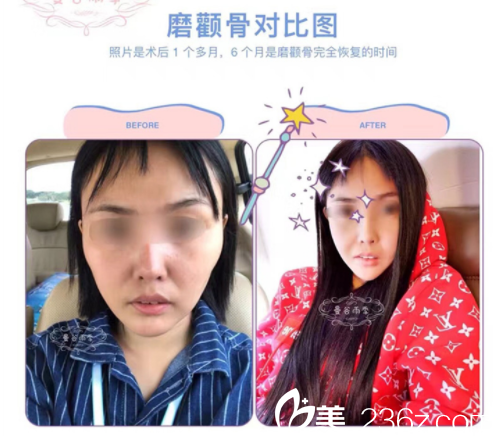 磨骨手術(shù)案例 磨骨手術(shù)案例