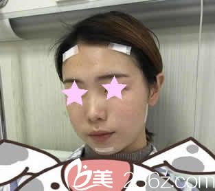 我在南寧東方整形做自體脂肪填充術(shù)后第3天照片 我在南寧東方整形做自體脂肪填充術(shù)后第3天照片