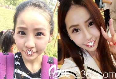 中國(guó)臺(tái)灣星和醫(yī)療玻尿酸隆鼻案例