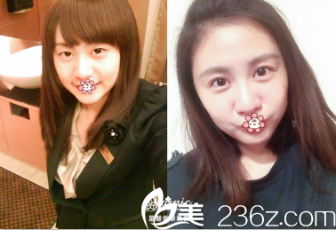 中國(guó)臺(tái)灣星和醫(yī)療雙眼皮案例