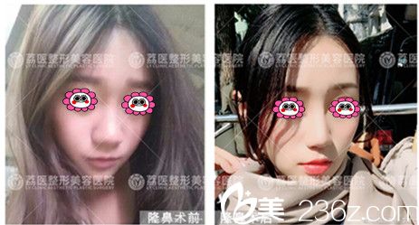 美極晶鉆全鼻塑形對比圖