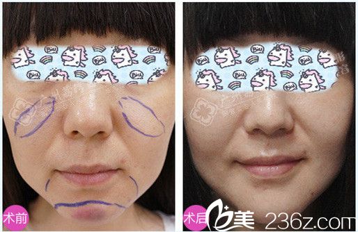 廣州荔灣醫(yī)院整形美容蘋果肌+下頦取奧美定前后照