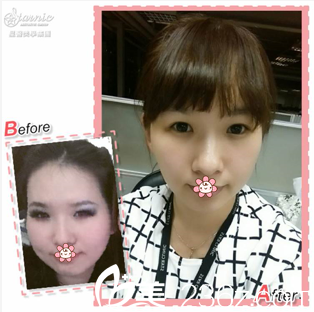 中國(guó)臺(tái)灣星和整形楊志雄Ultherapy極線音波拉提案例