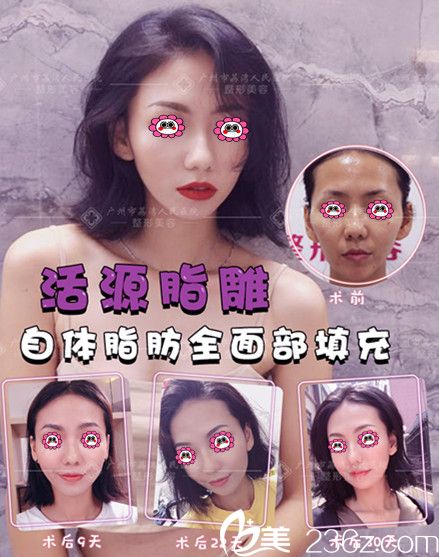 自體脂肪【   】部填充療效圖