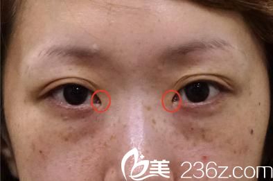 做白壁式雙眼皮前 做白壁式雙眼皮前