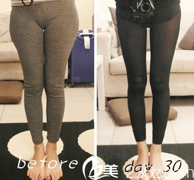 中國臺灣童顏醫(yī)療美容腿部吸脂案例