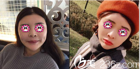 中國臺灣童顏醫(yī)療美容瘦臉除皺瘦臉案例