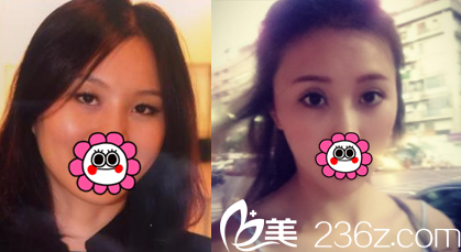 中國臺灣童顏醫(yī)療美容雙眼皮開眼角案例