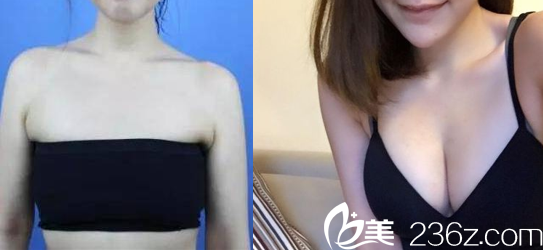 中國臺灣童顏醫(yī)療美容自體脂肪豐胸案例