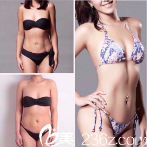 吳肇權(quán)院長抽脂案例 吳肇權(quán)院長抽脂案例