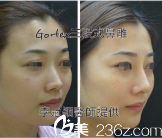 李冠穎三段式隆鼻案例 李冠穎三段式隆鼻案例