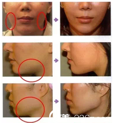 莊凱復線雕提升案例對比 莊凱復線雕提升案例對比