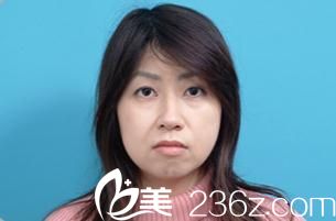 白壁征夫醫(yī)生為我進行面部拉皮手術(shù)提上日程 白壁征夫醫(yī)生為我進行面部拉皮手術(shù)提上日程