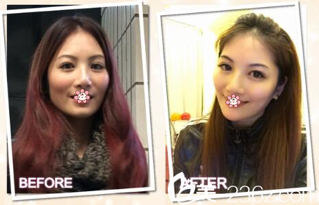 洪曼珊晶亮瓷填補(bǔ)下巴案例