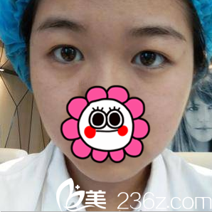 在中國臺灣童顏醫(yī)療美容醫(yī)院做切開雙眼皮前樣子 在中國臺灣童顏醫(yī)療美容醫(yī)院做切開雙眼皮前樣子