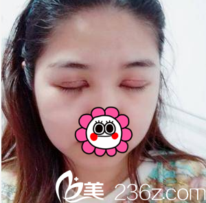 張智輝給我做切開雙眼皮第8天效果 張智輝給我做切開雙眼皮第8天效果