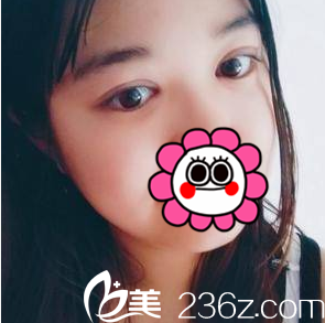 在中國臺灣童顏醫(yī)療美容醫(yī)院做切開雙眼皮第21天效果 在中國臺灣童顏醫(yī)療美容醫(yī)院做切開雙眼皮第21天效果