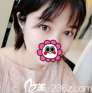 了解了中國臺灣童顏張智輝技術(shù)后看了雙眼皮案例我才做了切開雙眼皮