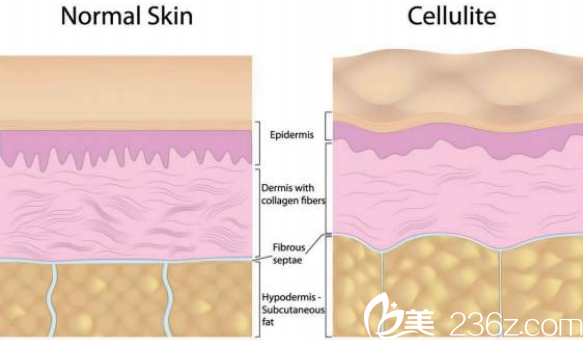 帕奧孫桐醫(yī)生講拉皮手術(shù)原理 帕奧孫桐醫(yī)生講拉皮手術(shù)原理