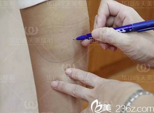 用筆畫出注射瘦腿的注射點 用筆畫出注射瘦腿的注射點