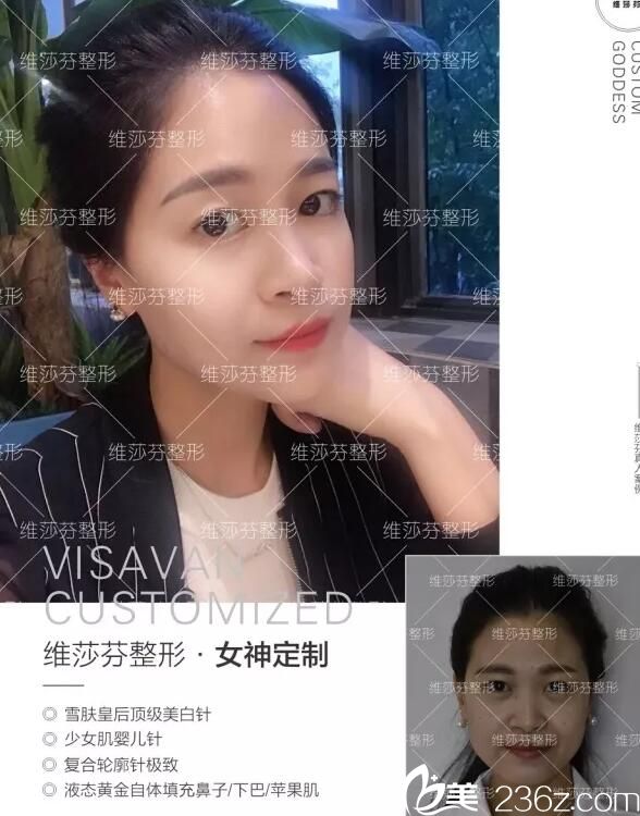 香港維莎芬整形怎么樣？來(lái)看真人蛻變案例