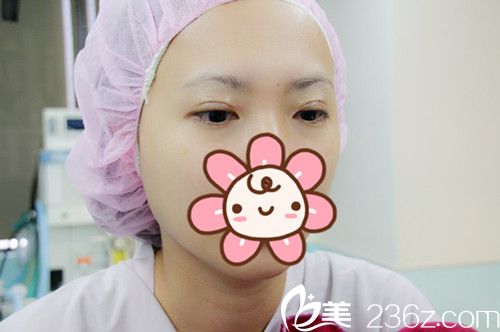 高義盛剛做完雙眼皮術(shù)后有流暢線條