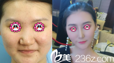 北京藝星薛軼群鼻綜合案例