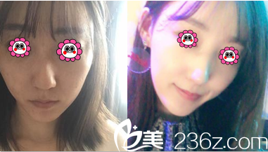 北京藝星陳玉連鼻修復(fù)案例