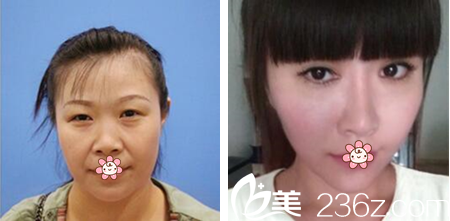 泰國(guó)曼谷KTOP整形巴尼厝洛雙眼皮隆鼻案例 泰國(guó)曼谷KTOP整形巴尼厝洛雙眼皮隆鼻案例