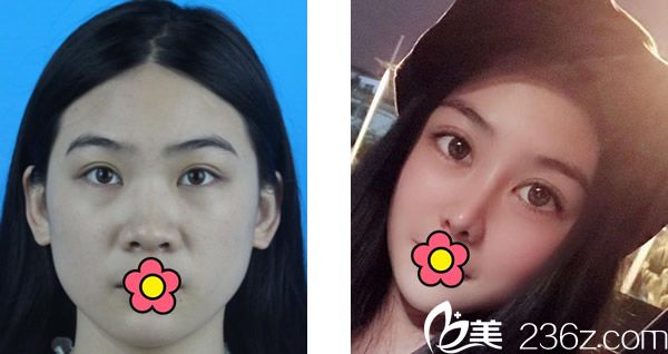 香港集美整形王洪醫(yī)生自體肋軟骨綜合隆鼻案例 香港集美整形王洪醫(yī)生自體肋軟骨綜合隆鼻案例